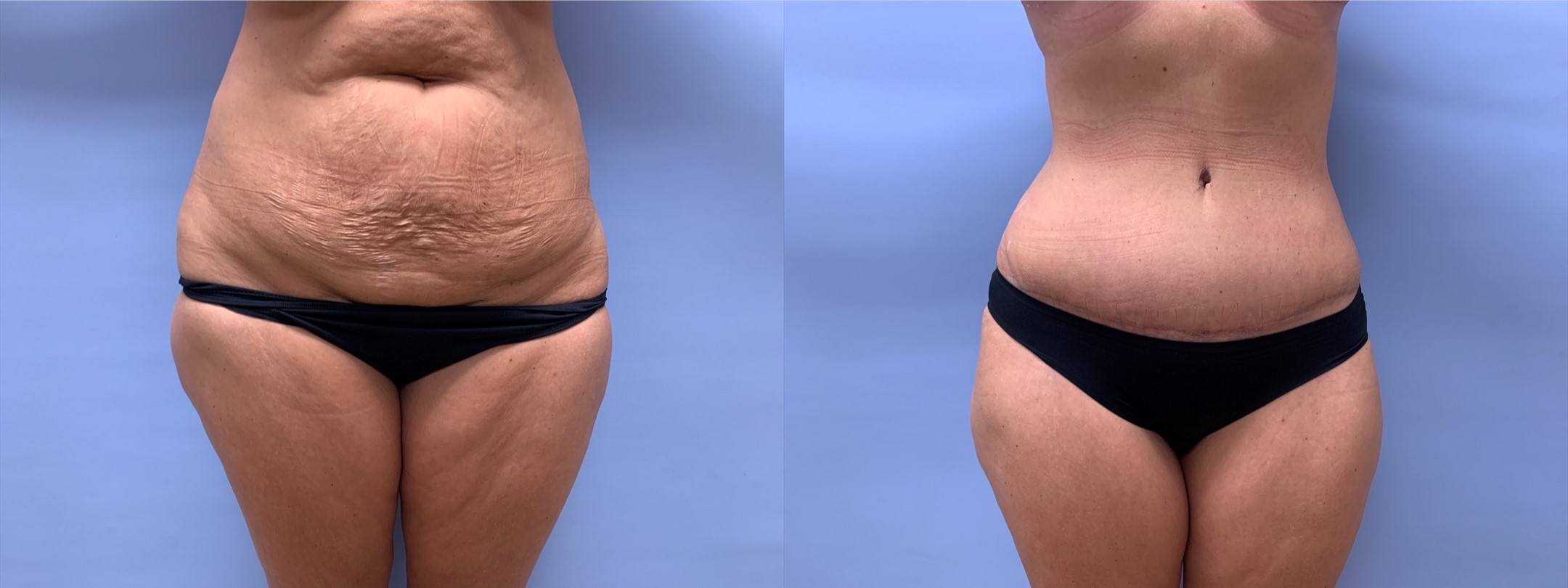 Tummy Tuck Patient 36 | Scottsdale Plastic Surgeon, Dr. Shaun Parson