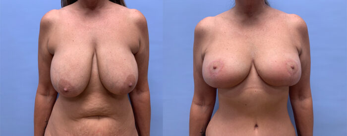 Breast Lift Patient 20 | Dr. Shaun Parson Scottsdale, AZ