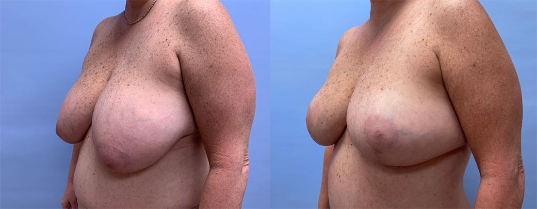 Breast Lift Patient 21 | Dr. Shaun Parson Plastic Surgery, Scottsdale