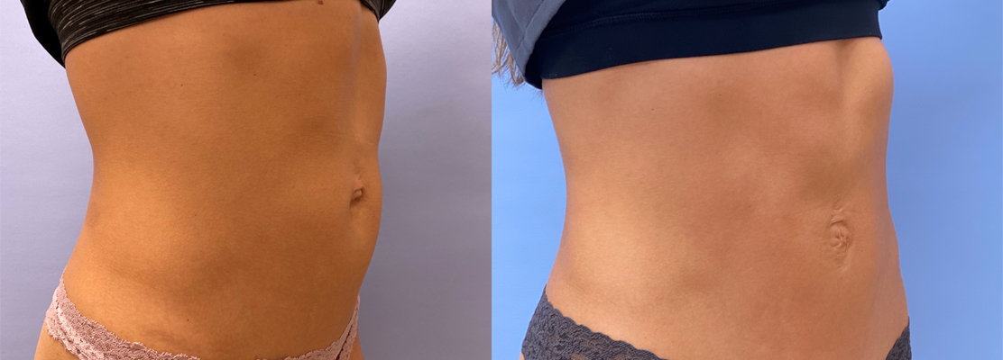 Mini Tummy Tuck Patient 37 | Dr. Shaun Parson Plastic Surgery, Scottsdale