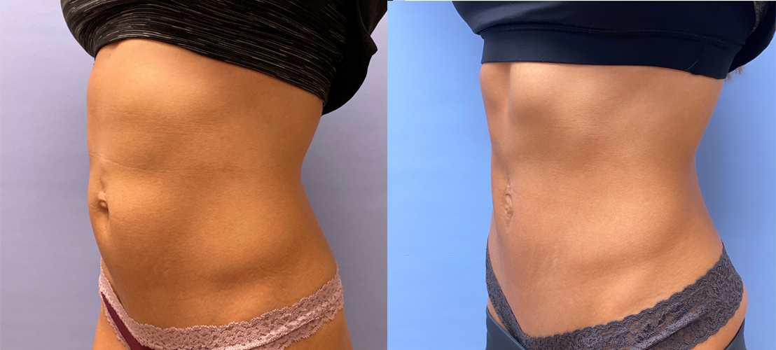 Mini Tummy Tuck Patient 37 | Dr. Shaun Parson Plastic Surgery, Scottsdale