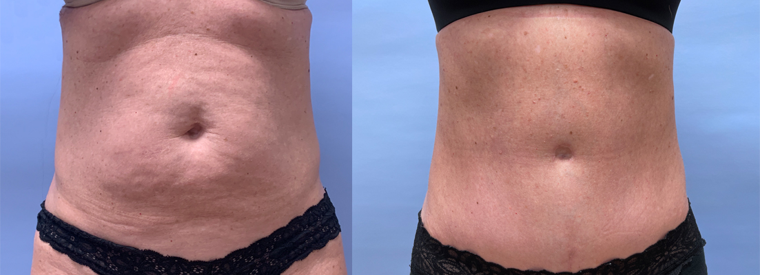 Tummy Tuck Patient 38 | Scottsdale Plastic Surgeon, Dr. Shaun Parson