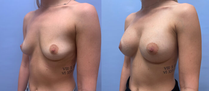 Breast Augmentation Patient 55 | Dr. Shaun Parson Scottsdale, AZ