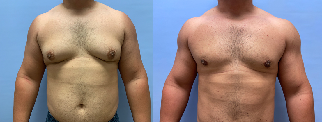 Gynecomastia Patient 18 | Scottsdale Plastic Surgeon Dr. Shaun Parson