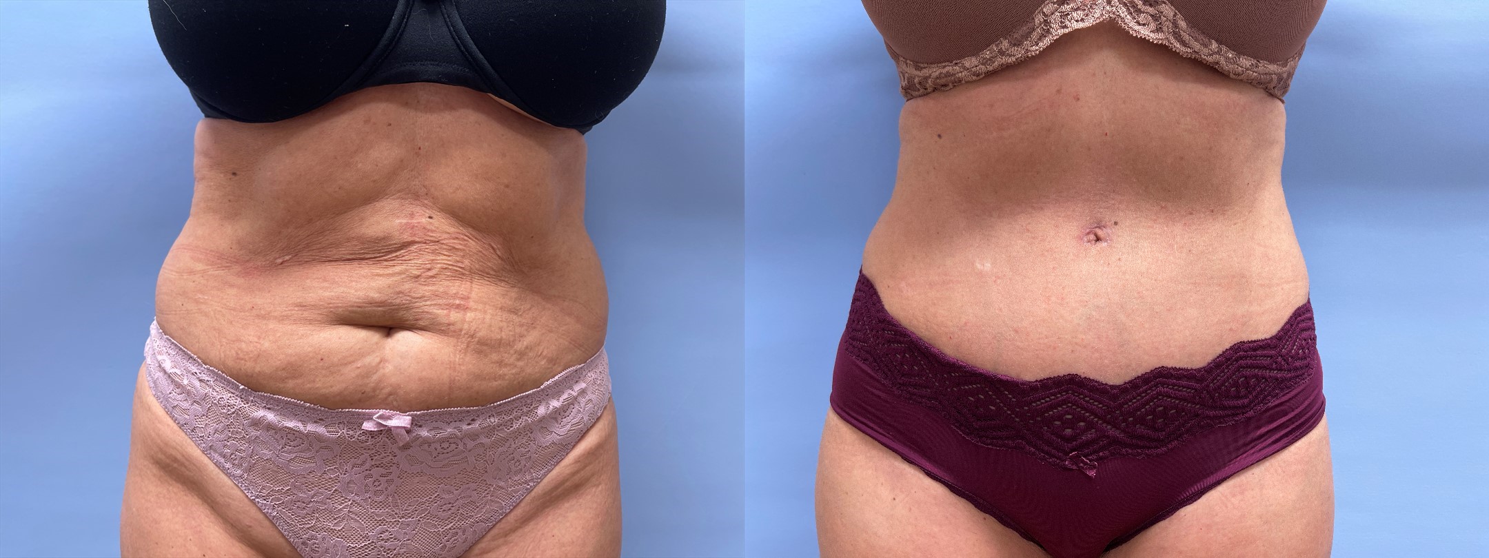 Tummy Tuck Patient 39 | Dr. Shaun Parson Plastic Surgery and Skin Center, Scottsdale