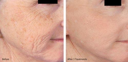 Microneedling | Dr. Shaun Parson Plastic Surgery and Skin Center | Scottsdale, Arizona