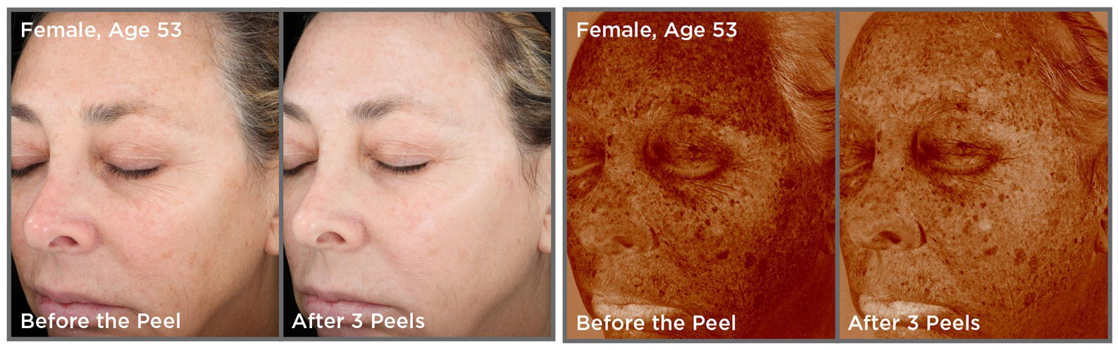 Vitalize Peel | Dr. Shaun Parson Plastic Surgery and Skin Center | Scottsdale, Arizona