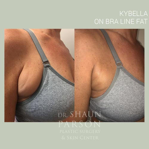 Kybella | Dr. Shaun Parson Plastic Surgery and Skin Center | Scottsdale, Arizona