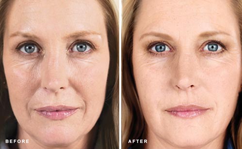 Sculptra | Dr. Shaun Parson Plastic Surgery and Skin Center | Scottsdale, Arizona