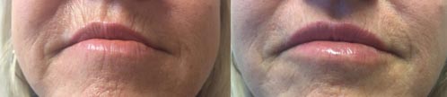 Fillers | Dr. Shaun Parson Plastic Surgery and Skin Center | Scottsdale, Arizona