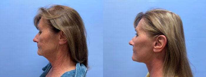 Facelift Patient 24 | Dr. Shaun Parson Plastic Surgery