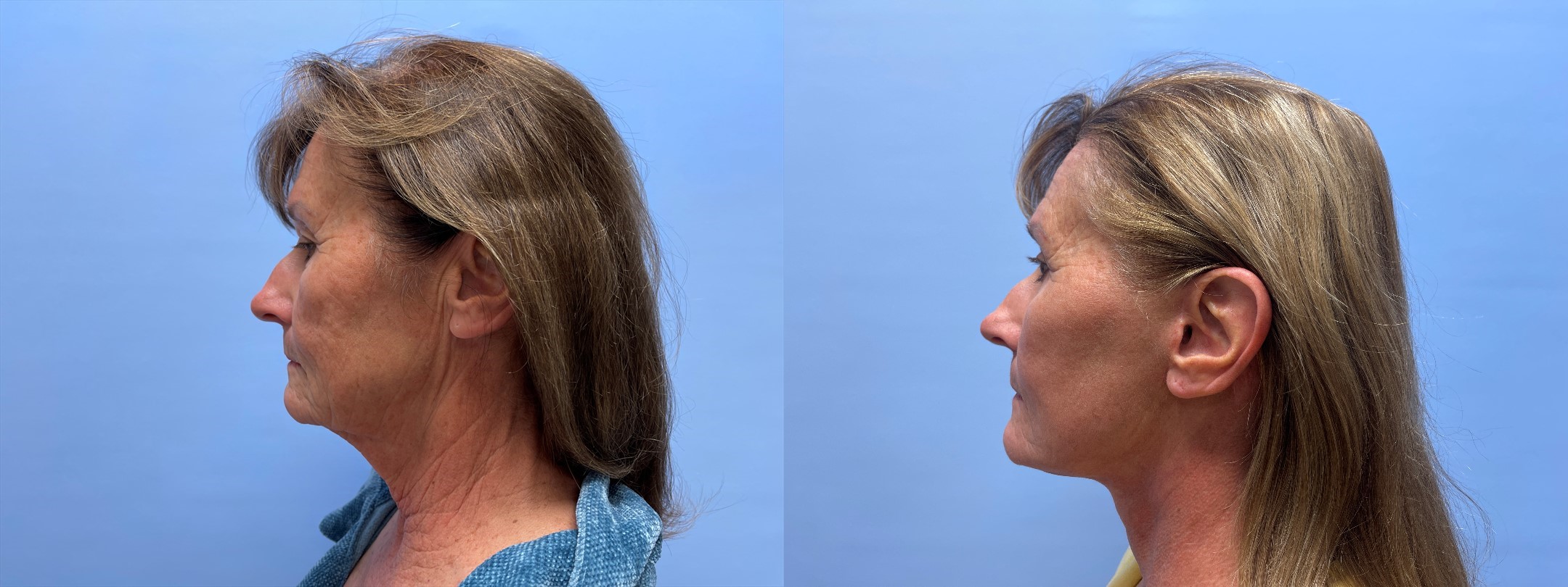 Facelift Patient 24 | Dr. Shaun Parson Plastic Surgery