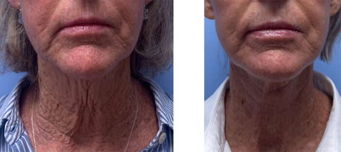 Necklift Patient 23 | Scottsdale Plastic Surgeon | Dr. Shaun Parson