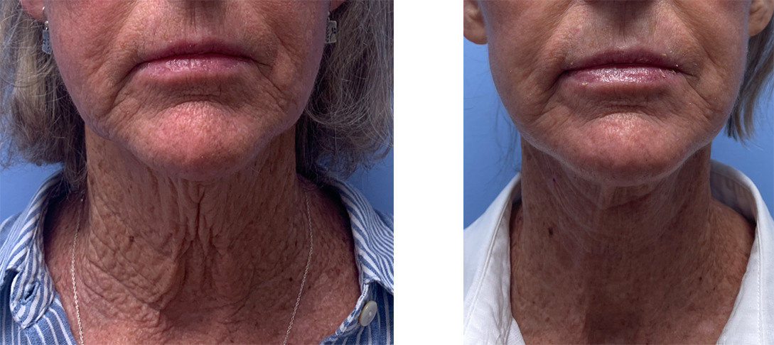 Necklift Patient 23 | Scottsdale Plastic Surgeon | Dr. Shaun Parson