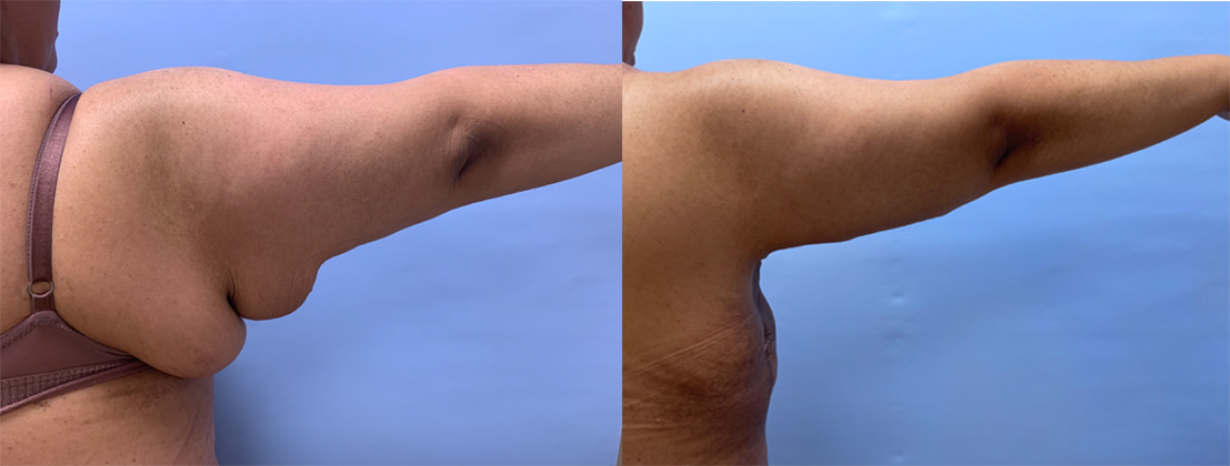 Arm Lift Patient 4 | Scottsdale Plastic Surgeon, Dr. Shaun Parson