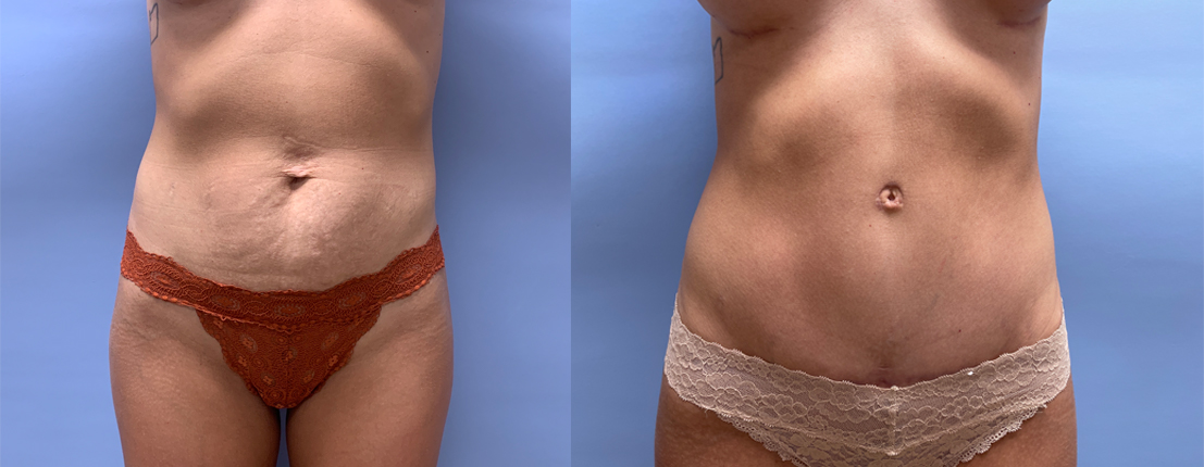 Tummy Tuck Patient 40 | Scottsdale Plastic Surgeon, Dr. Shaun Parson