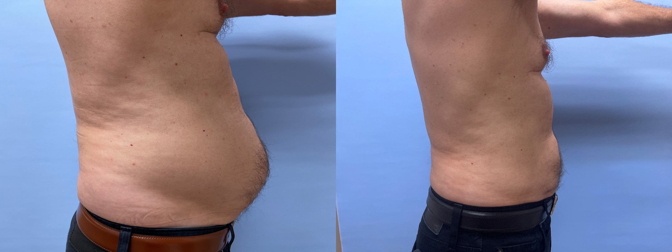 Liposuction Patient 22 | Scottsdale Plastic Surgeon, Dr. Shaun Parson