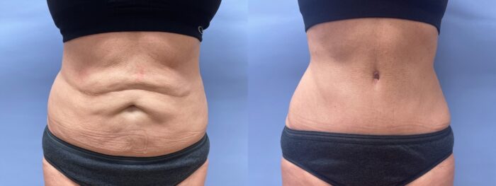 Tummy Tuck Patient 41 | Scottsdale Plastic Surgeon, Dr. Shaun Parson