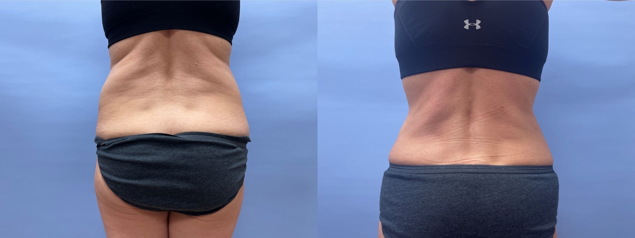 Tummy Tuck Patient 41 | Scottsdale Plastic Surgeon, Dr. Shaun Parson