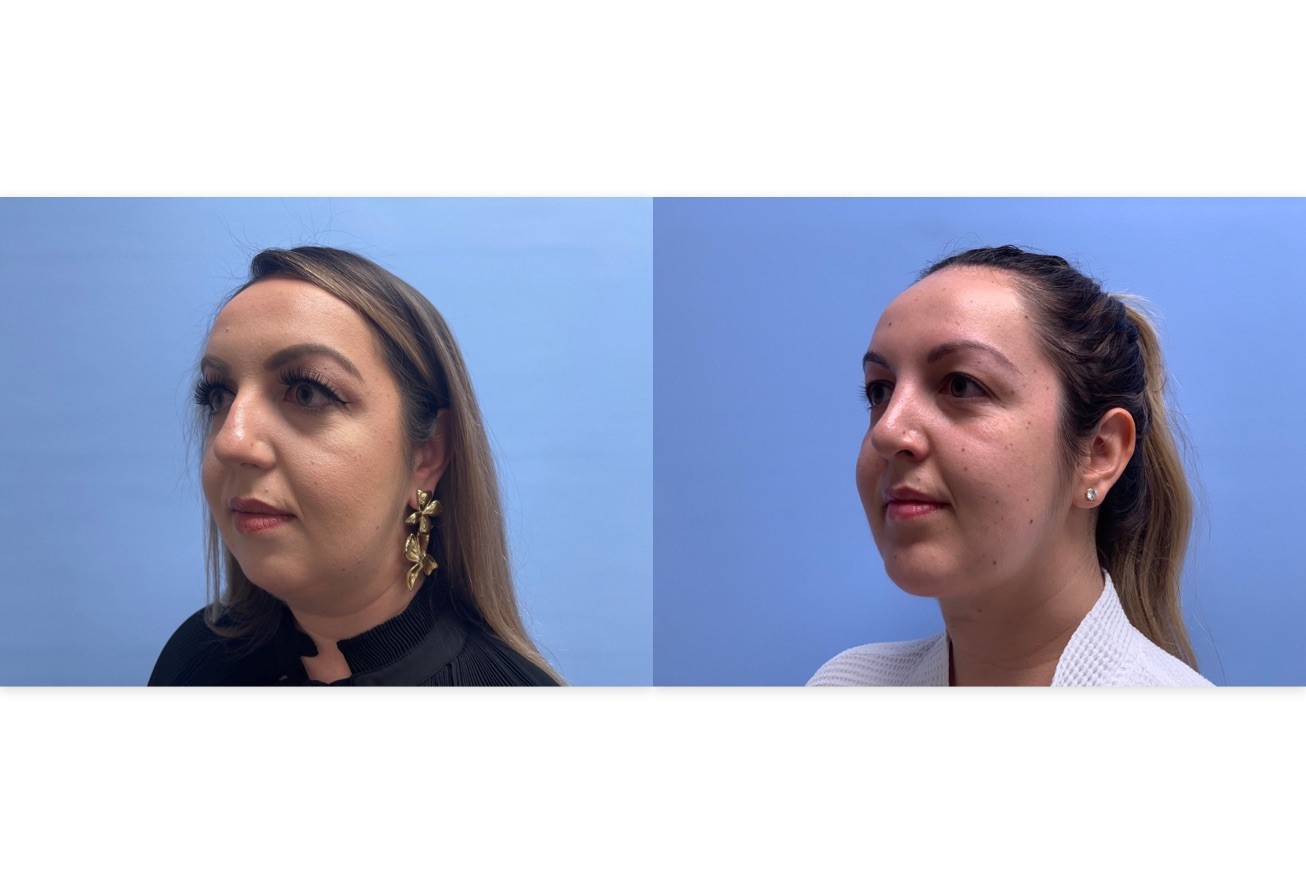 Rhinoplasty Patient 10 | Dr. Shaun Parson Plastic Surgery, Scottsdale