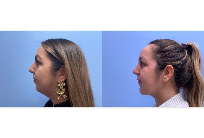 Rhinoplasty Patient 10 | Dr. Shaun Parson Plastic Surgery, Scottsdale