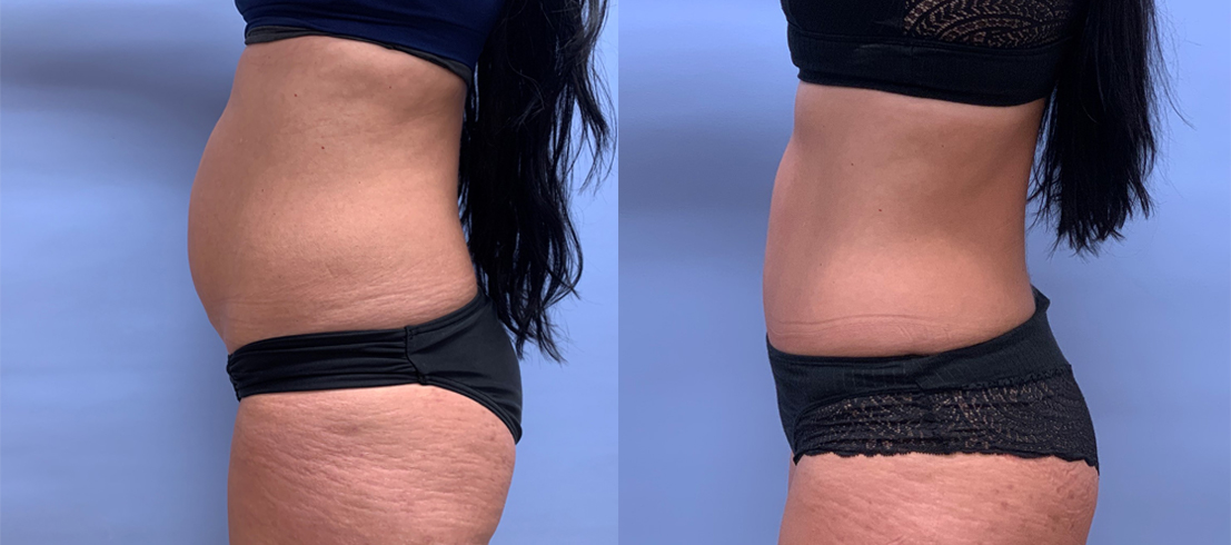 Tummy Tuck Patient 43 | Scottsdale Plastic Surgeon, Dr. Shaun Parson