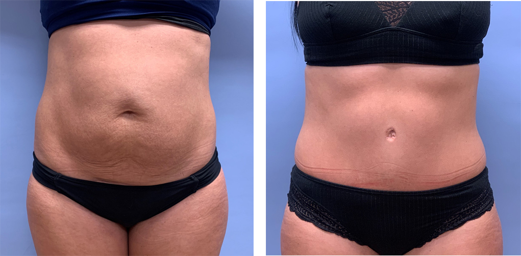 Tummy Tuck Patient 43 | Scottsdale Plastic Surgeon, Dr. Shaun Parson