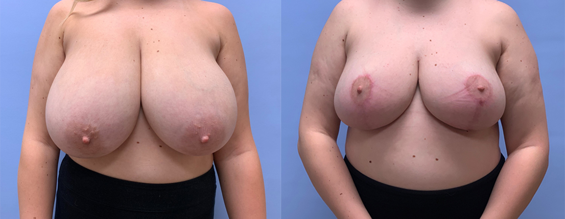 Breast Lift Patient 22 | Scottsdale Plastic Surgeon, Dr. Shaun Parson