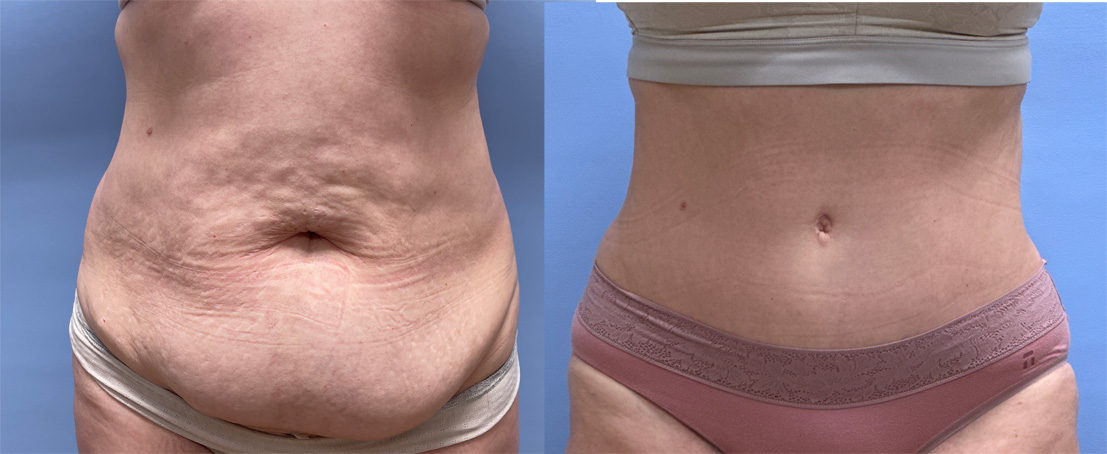 1 Year post -op Tummy Tuck, Scottsdale AZ