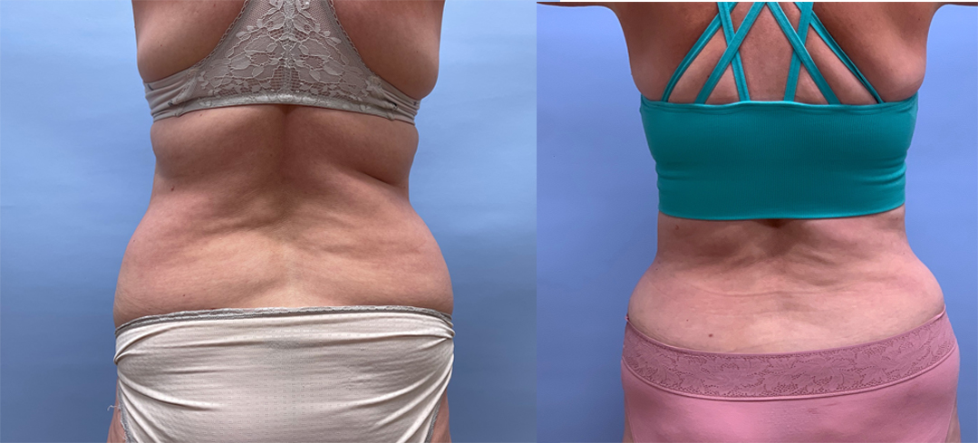 Tummy Tuck Patient 43 | Scottsdale Plastic Surgeon, Dr. Shaun Parson