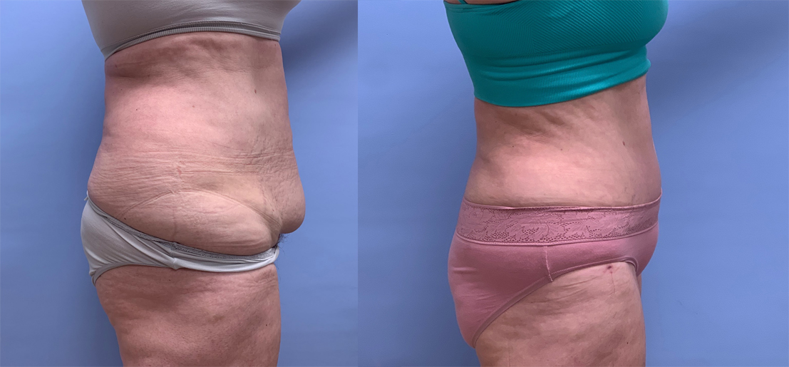 Tummy Tuck Patient 43 | Scottsdale Plastic Surgeon, Dr. Shaun Parson