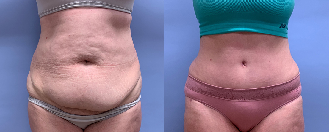 Tummy Tuck Patient 43 | Scottsdale Plastic Surgeon, Dr. Shaun Parson