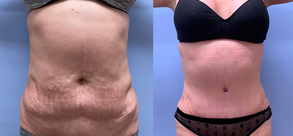 Tummy Tuck Patient 44 | Scottsdale Plastic Surgeon, Dr. Shaun Parson