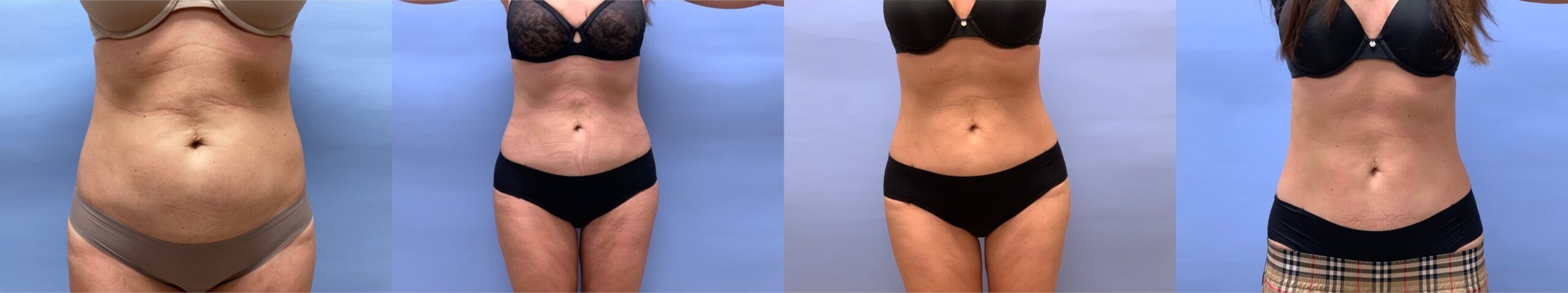 Liposuction + 4 Emsculpts | Dr. Shaun Parson Plastic Surgery & Skin Center