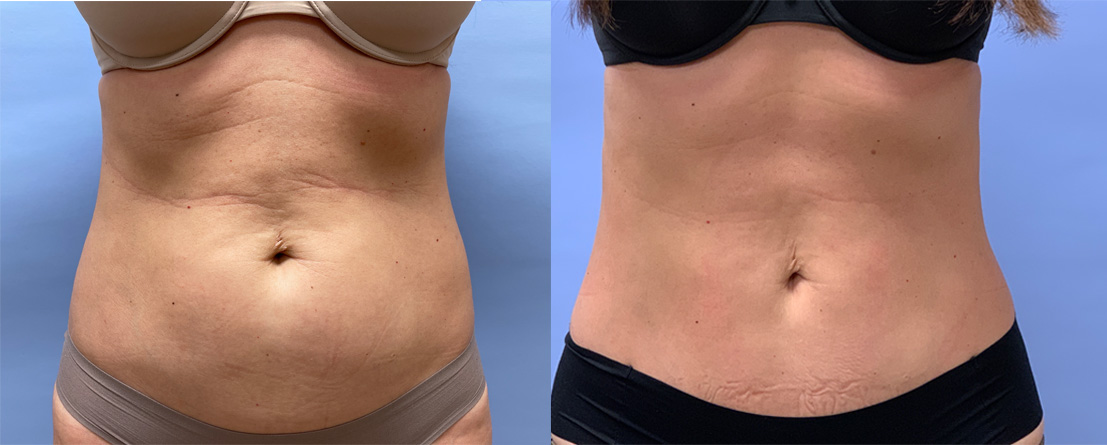 Liposuction + Emsculpt | Dr. Shaun Parson Plastic Surgery