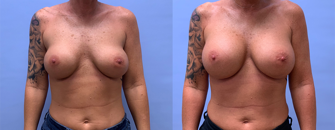 Breast Revision 19 | Scottsdale Plastic Surgeon, Dr. Shaun Parson