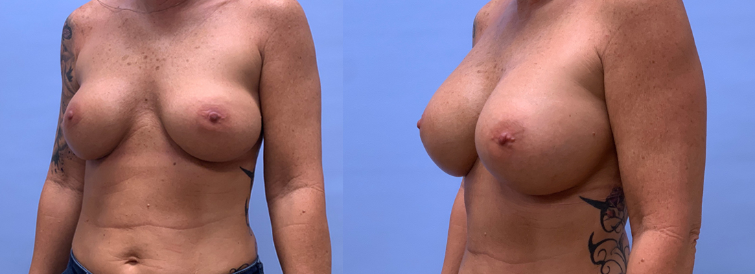 Breast Revision 19 | Scottsdale Plastic Surgeon, Dr. Shaun Parson