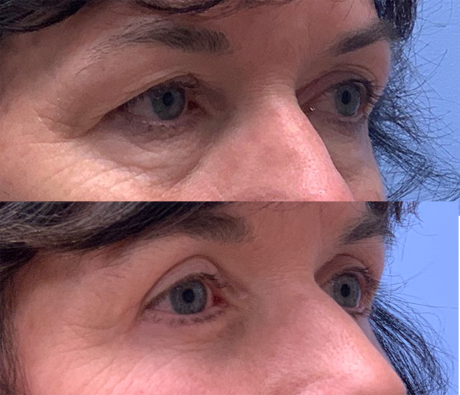 Quad Blepharoplasty Patient 35 | Dr. Shaun Parson Plastic Surgery, Scottsdale