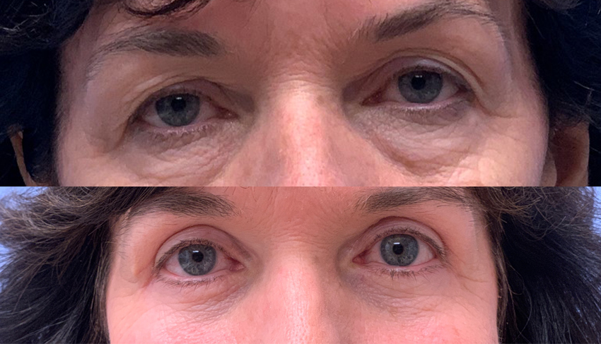 Quad Blepharoplasty Patient 35 | Dr. Shaun Parson Plastic Surgery, Scottsdale