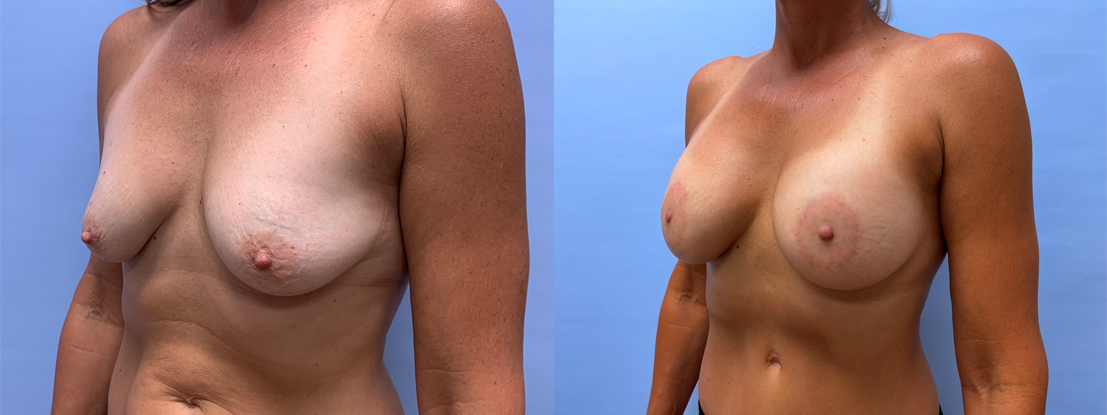 Breast Lift with Peri-Areolar Augmentation | Dr. Shaun Parson, Scottsdale