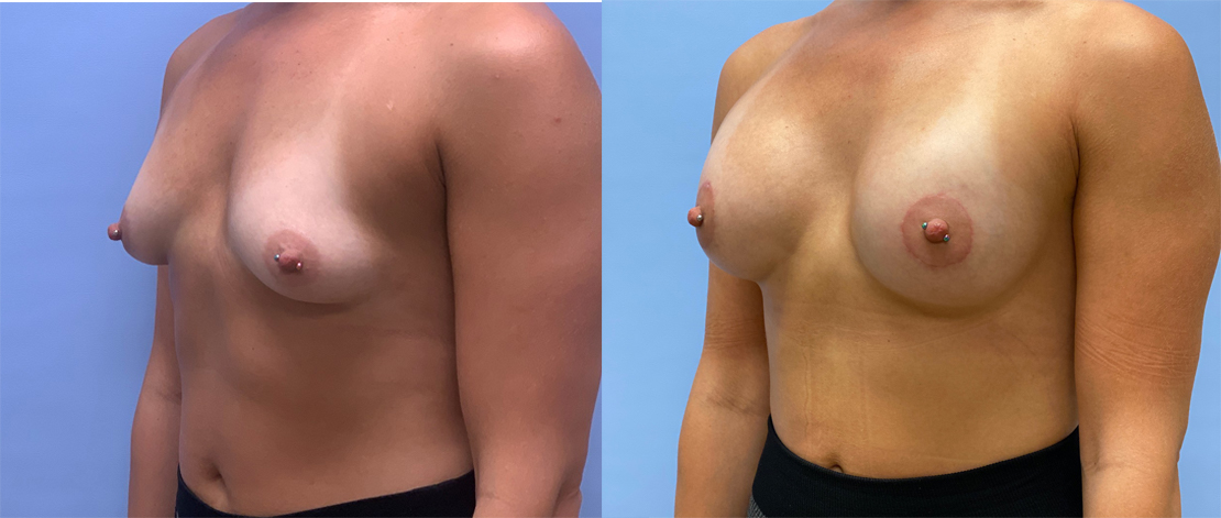 Breast Augmentation Patient 56 | Dr. Shaun Parson, Scottsdale