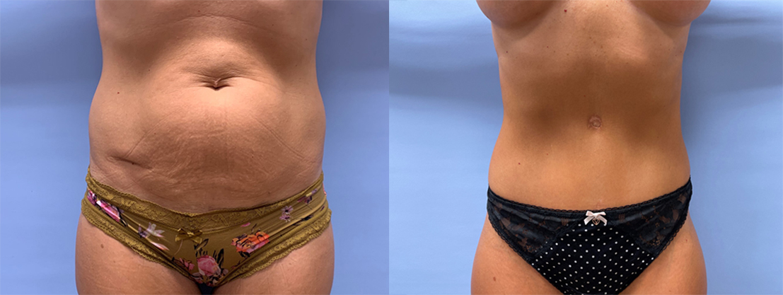 Tummy Tuck Patient 45 | Dr. Shaun Parson Plastic Surgery and Skin Center