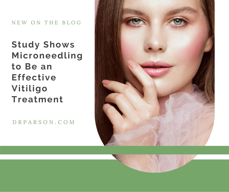 Study Shows Microneedling to Effective for Vitiligo | Dr. Shaun Parson