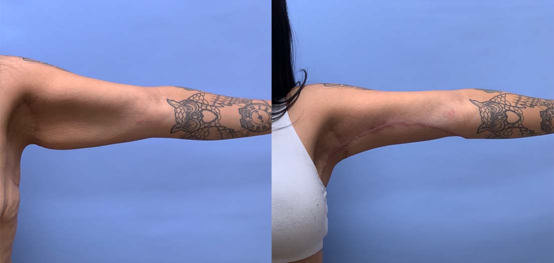 Arm Lift Patient 5 | Dr. Shaun Parson Plastic Surgery, Scottsdale, AZ