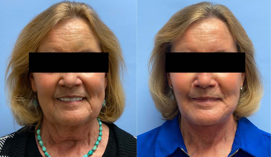 Necklift + Lower Facelift Patient 26 | Dr. Shaun Parson Plastic Surgery