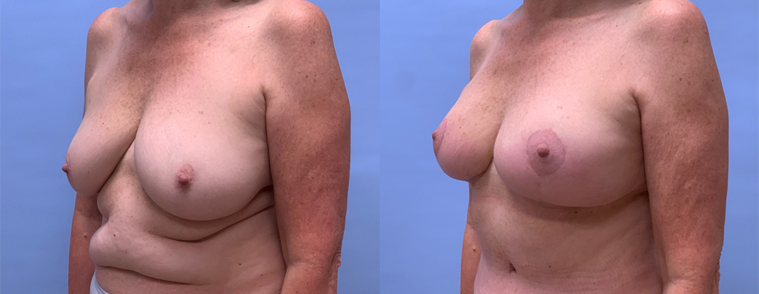 Breast Lift Patient 23 | Dr. Shaun Parson Plastic Surgery