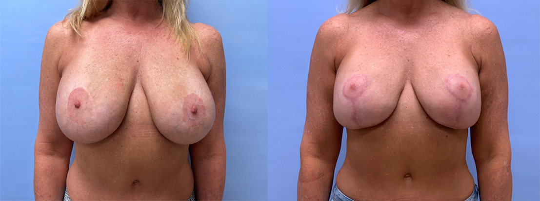 Breast Lift with Augmentation Patient 23 | Dr. Shaun Parson Plastic Surgery