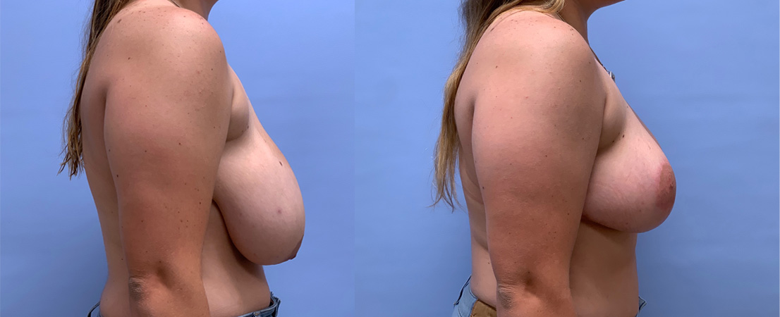 Breast Lift Patient 24 | Dr. Shaun Parson Plastic Surgery, Scottsdale, AZ