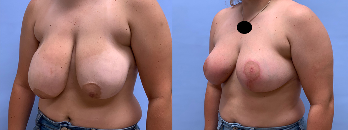 Breast Lift Patient 24 | Dr. Shaun Parson Plastic Surgery, Scottsdale, AZ