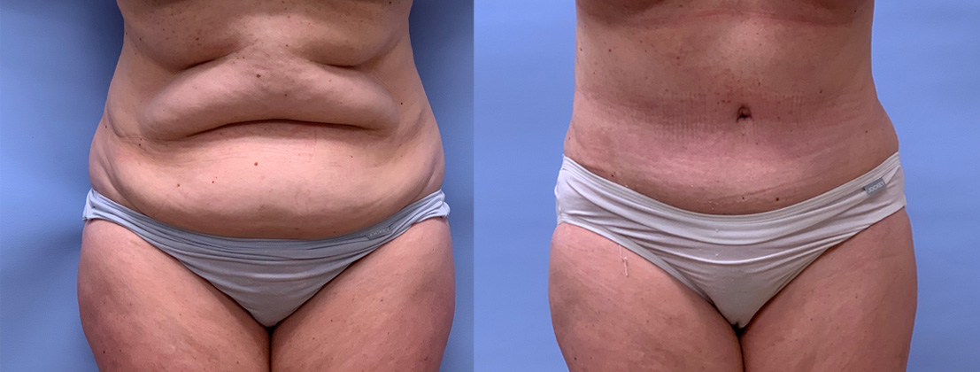 Tummy Tuck Patient 47 | Dr. Shaun Parson Plastic Surgery